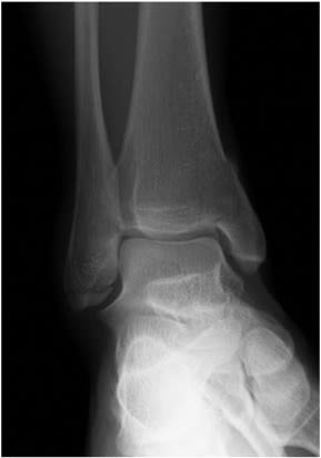Ankle Implant